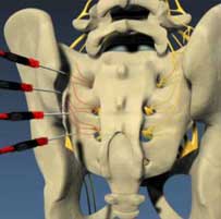 SI joint RF ablation